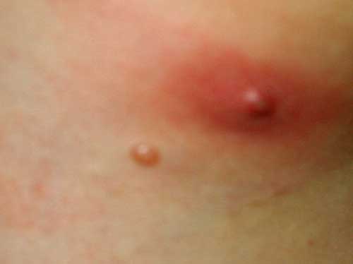 Pimple Like Rash On Chest And Back - healthtap.com